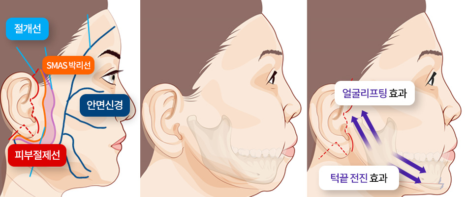 리프팅/안면거상술