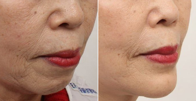 So sánh trước và sau phẫu thuật