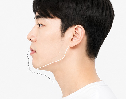 ก่อนปรับตำแหน่งขากรรไกร