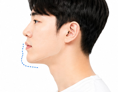 หลังปรับตำแหน่งขากรรไกร